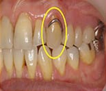 従来の部分入れ歯